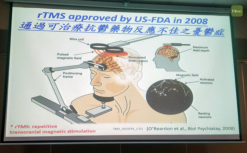 忧郁症困扰20年 30分钟内的经颅磁刺激治疗2周即改善