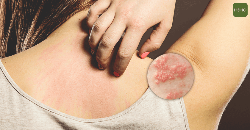 皮膚一粒粒癢癢抓不停　到底是濕疹還是異位性皮膚炎？