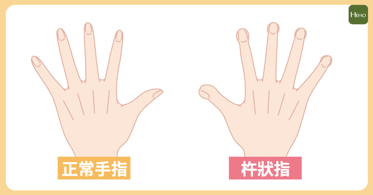 「杵狀指」可能是肺癌前兆!癌細胞刺激骨頭增生導致疼痛 - Heho Cancer