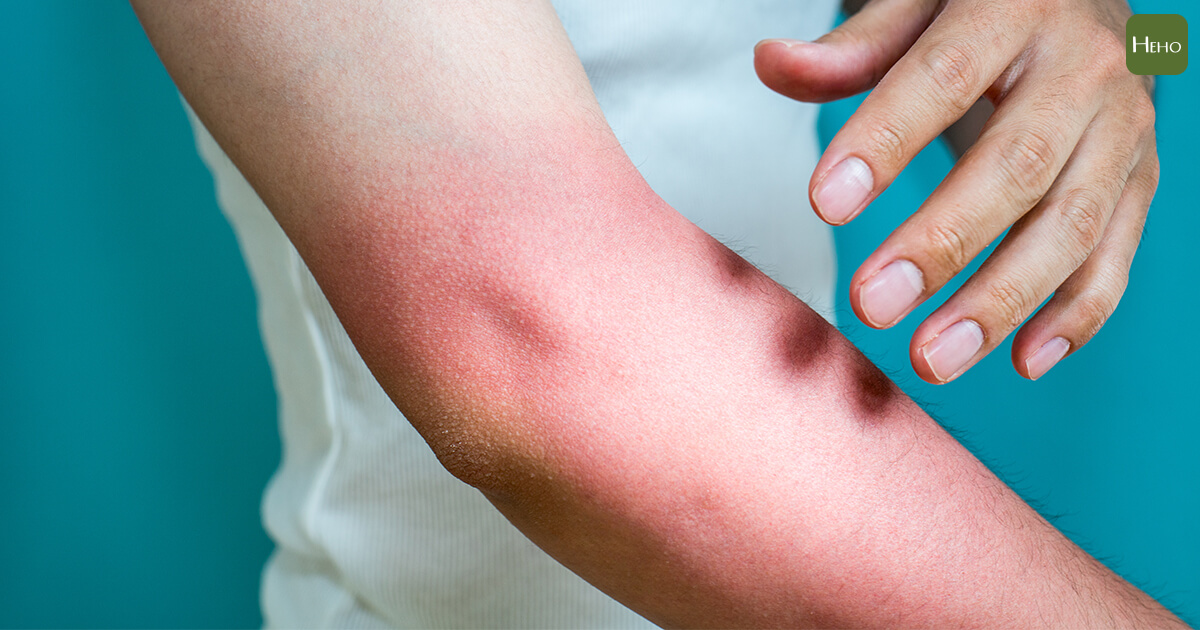 夏天皮膚容易癢 原來是光敏感