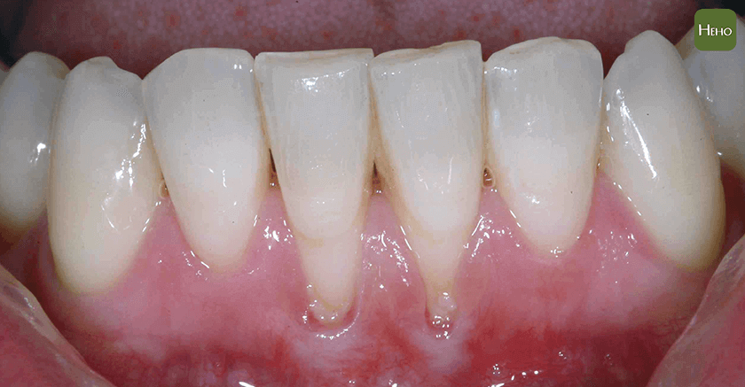 牙齦腫是牙周病嗎？犀利士價錢教你用4招紅、腫、軟、鬆判斷