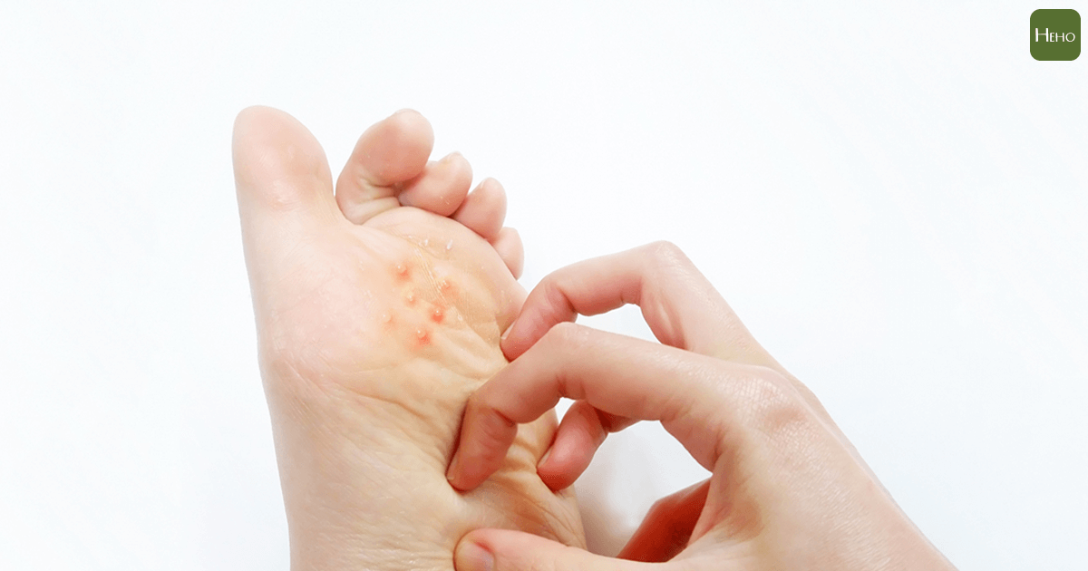 腳上長水泡不一定是香港腳 還有可能是超難根治的汗皰疹