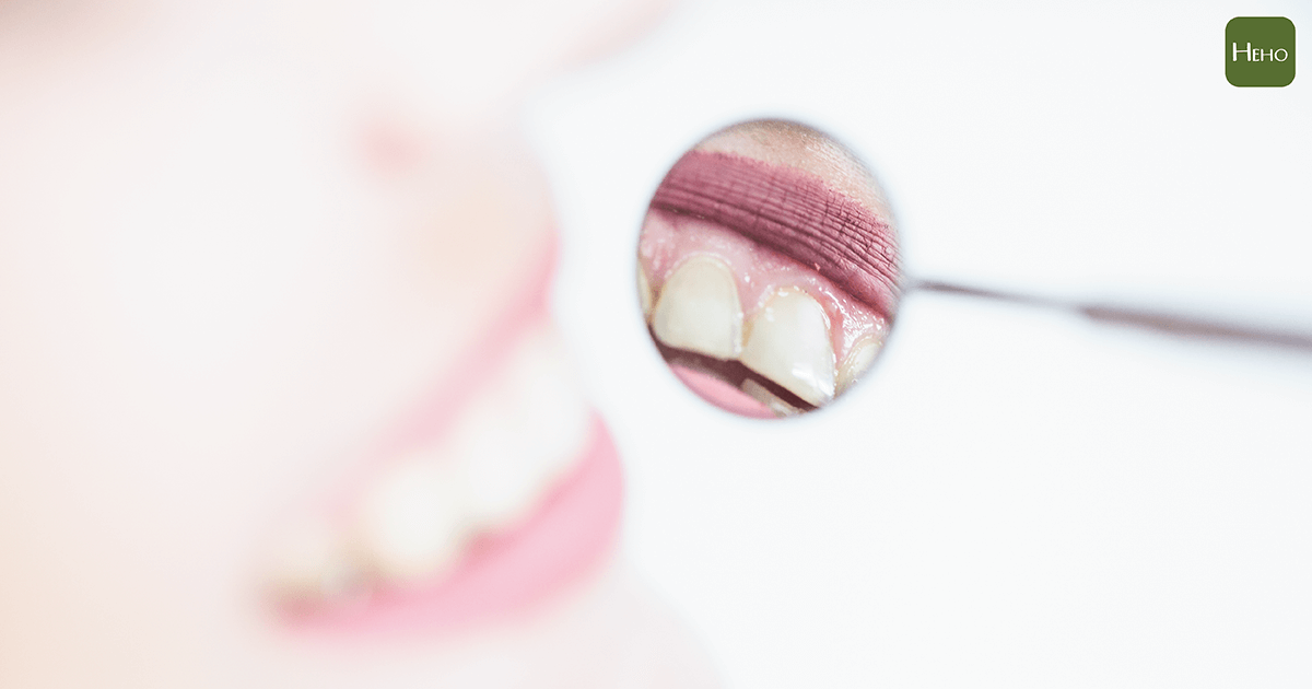 牙齦腫是牙周病嗎？犀利士價錢教你用4招紅、腫、軟、鬆判斷