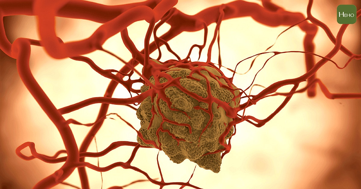 肝臟發現血管瘤會變成癌症嗎？養肝該這樣做！