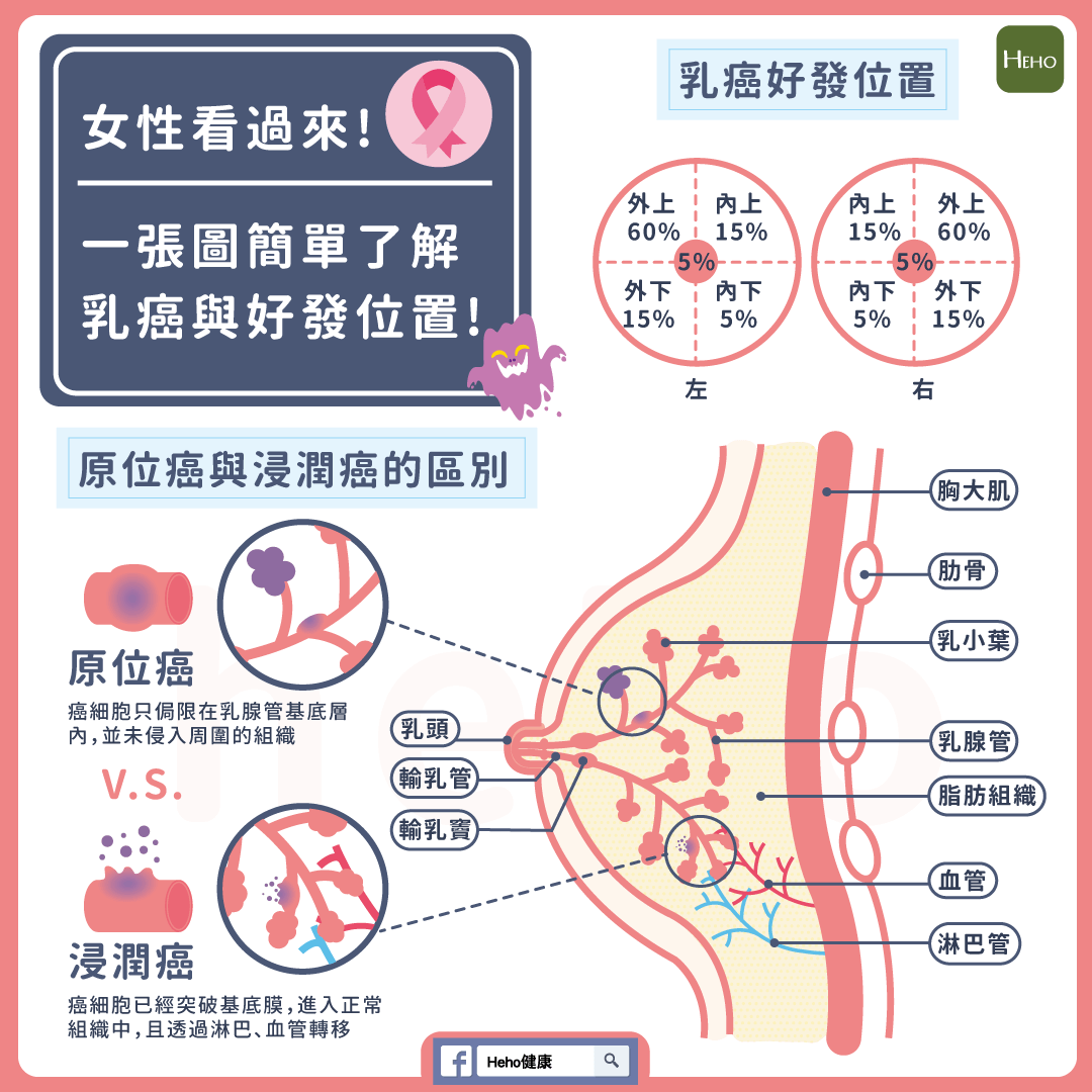 Who 乳癌分類, 乳がん ステージ ガイドライン : 乳癌取扱い規約第18版の改正点 – ITOC
