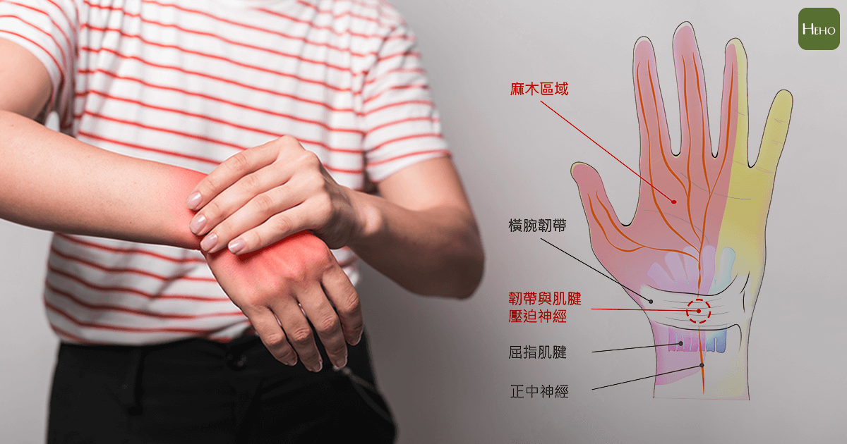 手麻懷疑是腕隧道症候群?在家一招即可自我檢測 | Heho健康