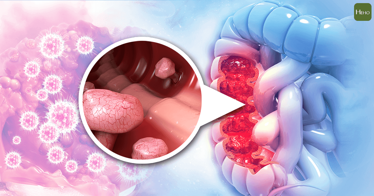 大腸瘜肉不切除-絕對變成大腸癌