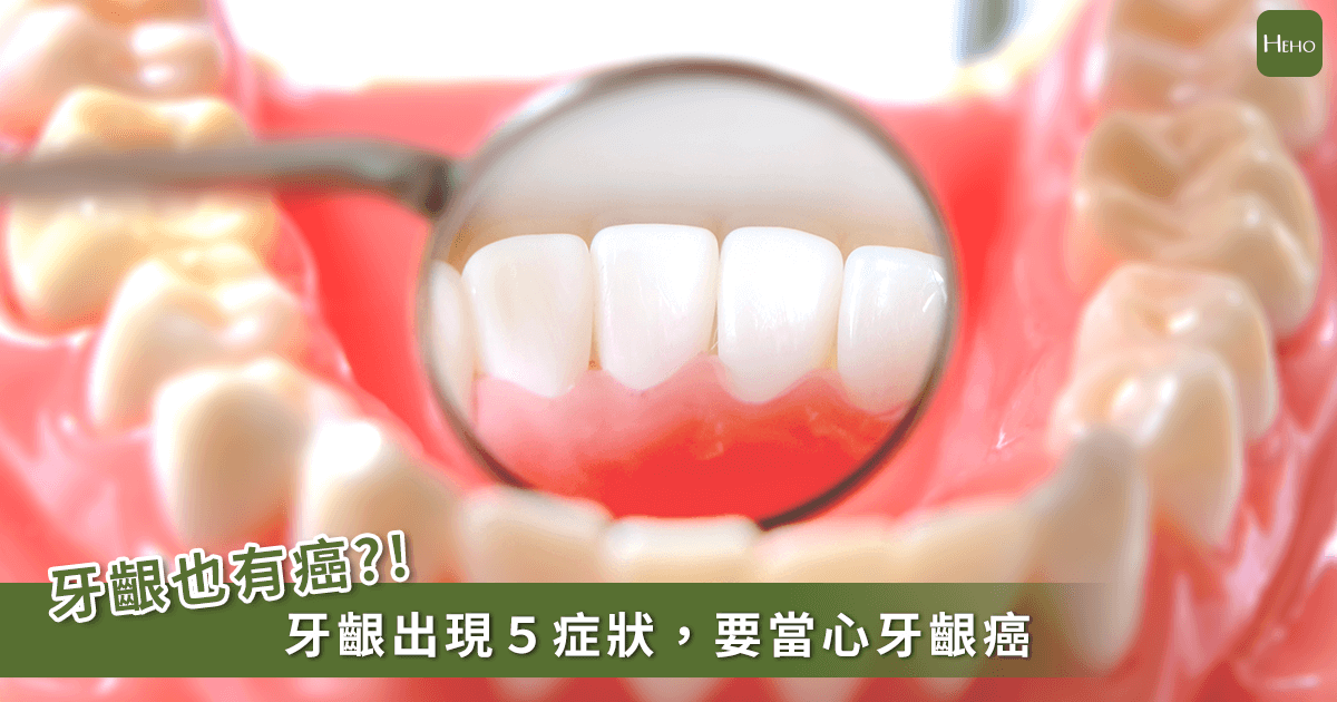 20191216-牙齦