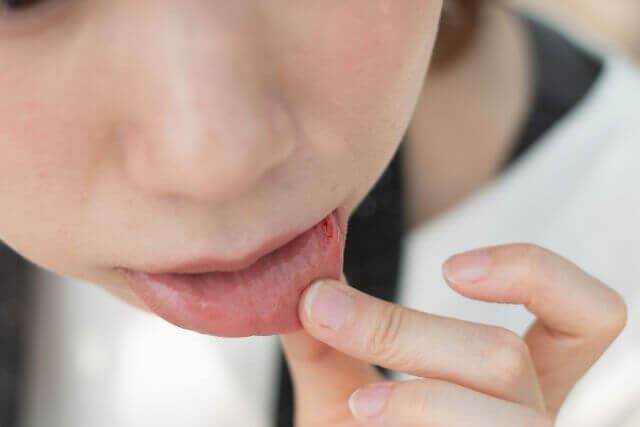 嘴唇是健康的紅綠燈！用5個症狀了解身體狀態