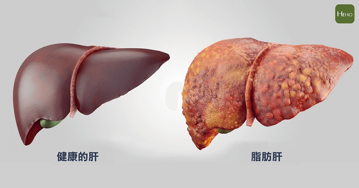 脂肪肝是肝臟健康殺手！美國營養學專家用3種食物幫助清掉多餘脂肪