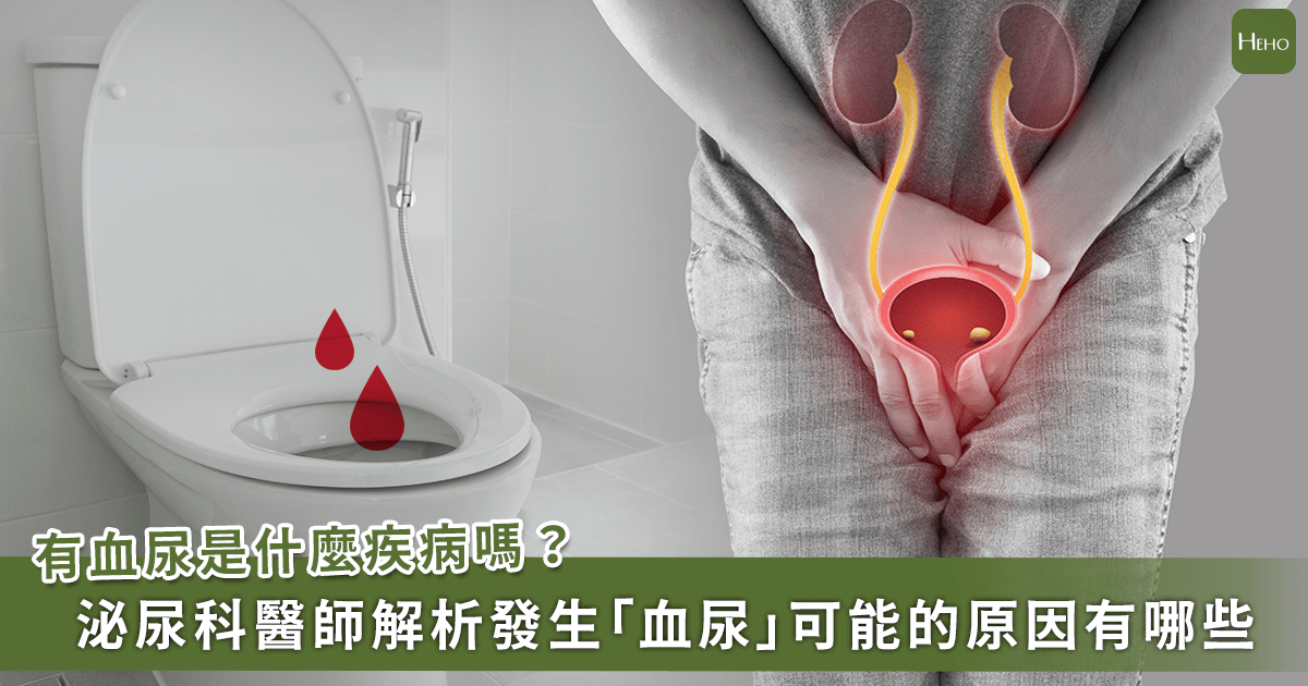 出現「血尿」可能是哪些疾病？不會痛的血尿更要注意