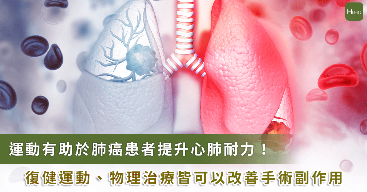 20221213_肺癌患者運動「肺」更好！術前衛教、運動訓練助適應手術副作用