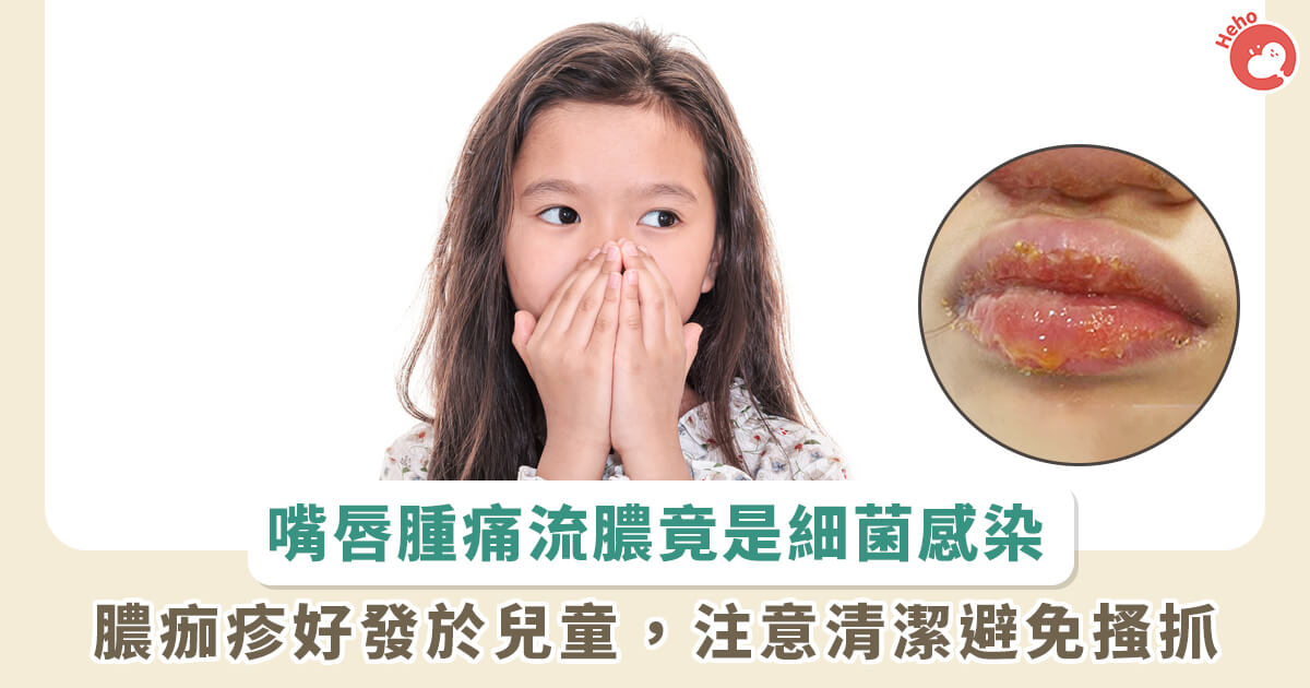 20230504_嘴唇腫痛流膿竟是細菌感染 膿痂疹好發於兒童，注意清潔避免搔抓