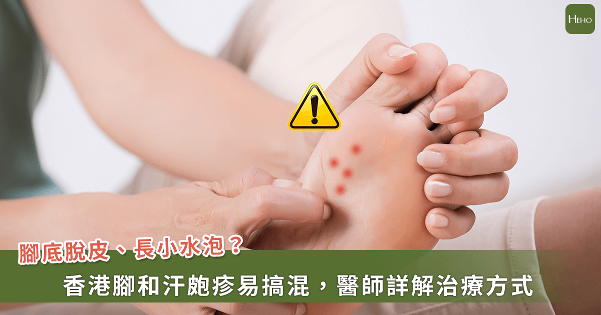 腳上長出小水泡「是汗皰疹？還是香港腳？」這 2 疾病常搞錯