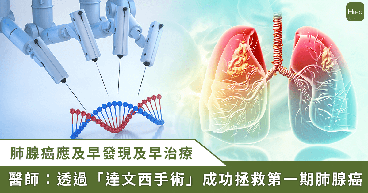 20250513_健檢揪出肺結節無症狀！「第一期肺腺癌」　達文西手術切除續命