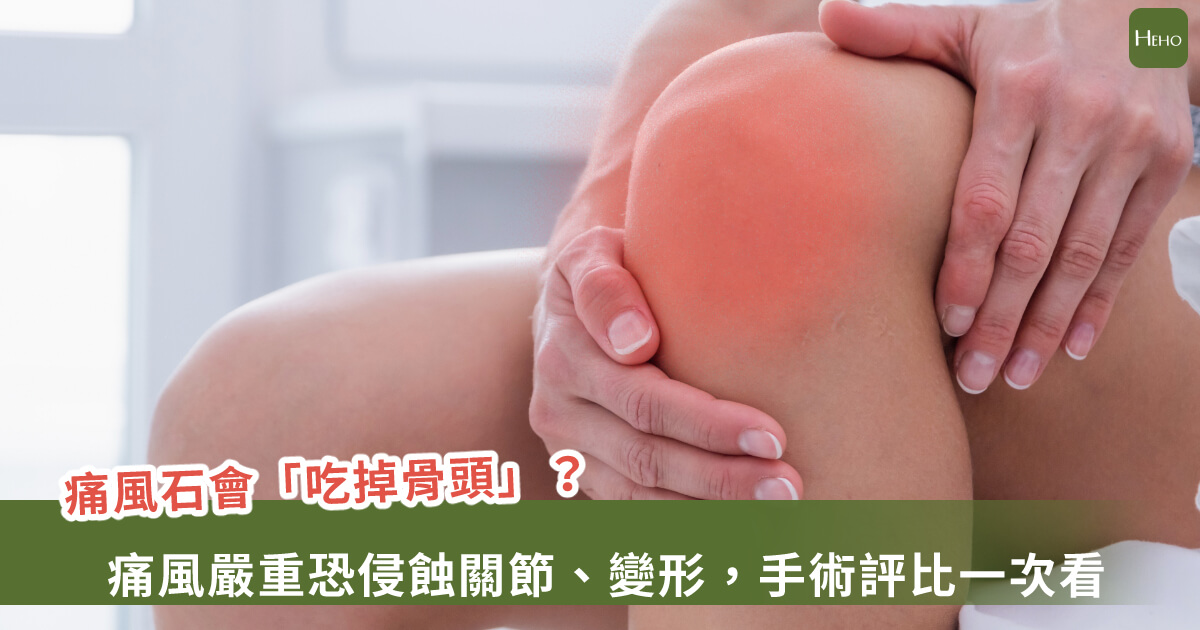 痛風石長成乒乓球大怎麼辦？傳統手術VS新式水刀微創比較一次看