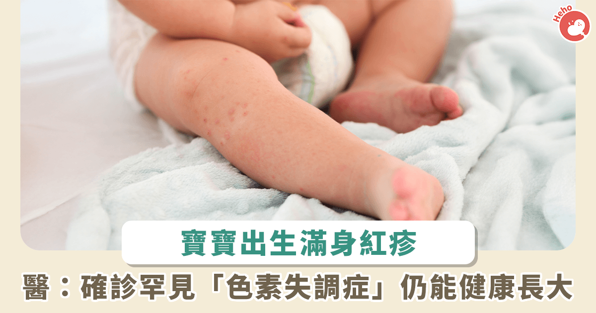 250904色素失調症
