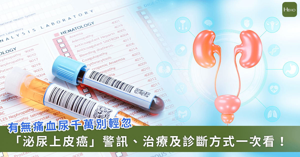 20251030_-排尿時哪些問題要注意?「泌尿上皮癌」太晚發現存活率降至-2-成 20251030_-排尿時哪些問題要注意?「泌尿上皮癌」太晚發現存活率降至-2-成