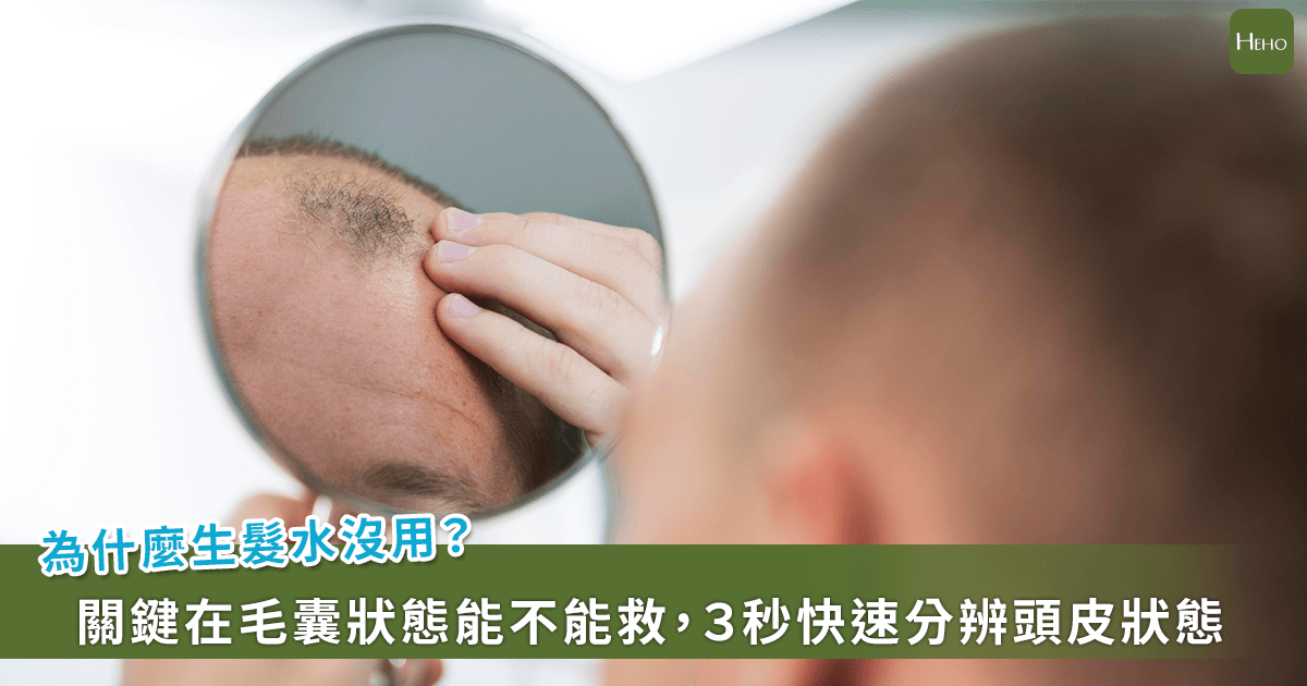 掉髮擦藥沒用？趙昭明醫師「毛囊存活測試」3 秒辨毛囊生死